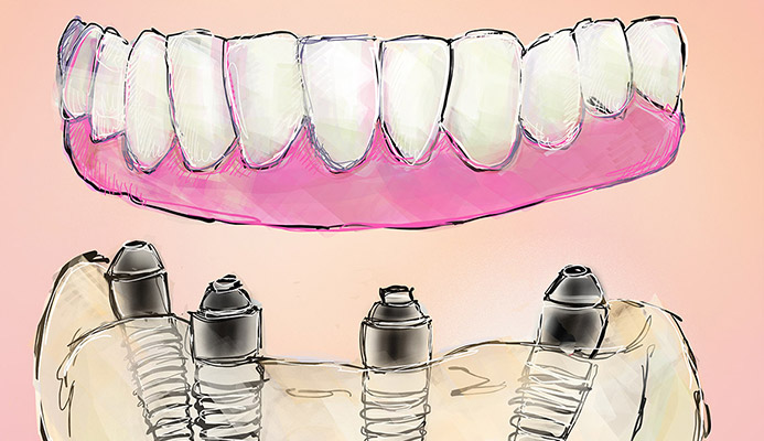 Impianti dentali in centro a Milano