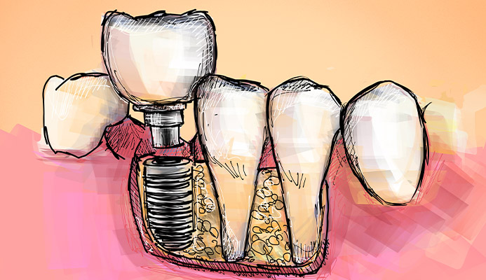 Impianti dentali in centro a Milano