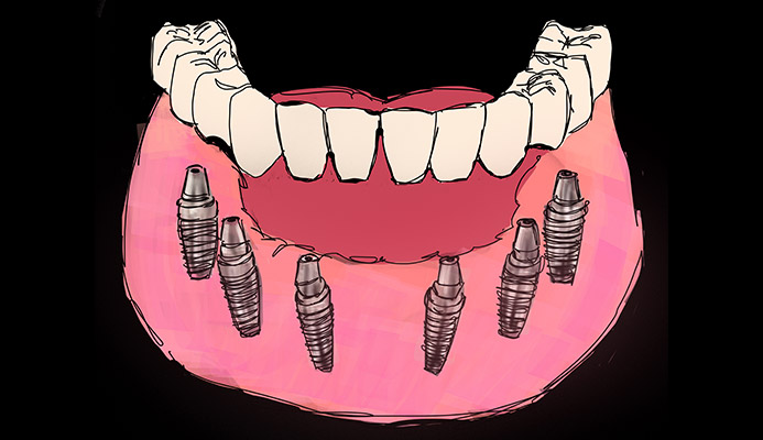 Impianti dentali in centro a Milano