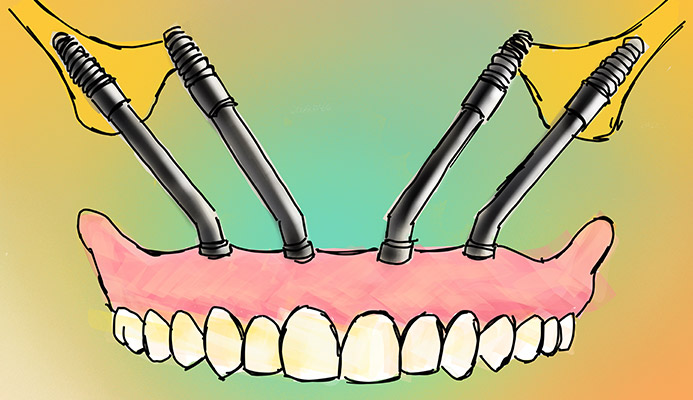 Impianti dentali in centro a Milano