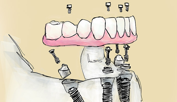 Impianti dentali in centro a Milano